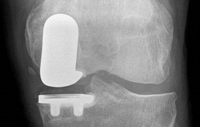 Outpatient Knee Replacement:  The Great Debate The Stone Clinic