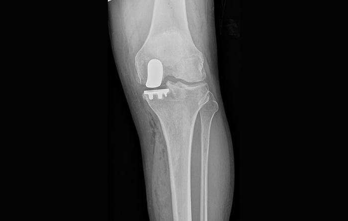 What is a Partial Knee Replacement