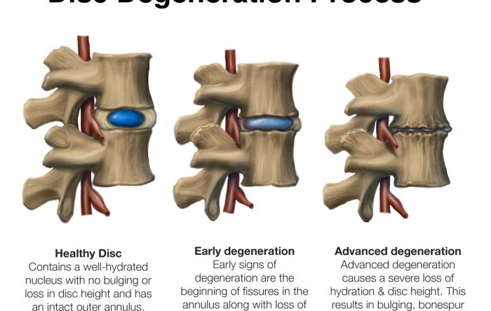 Spinal Disc Degeneration - Arthritis Formation 