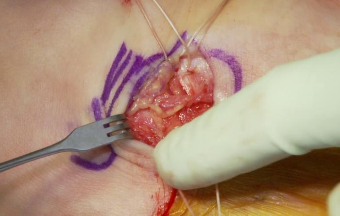 Embedded thumbnail for Stone Ankle Ligament Repair Surgery Video