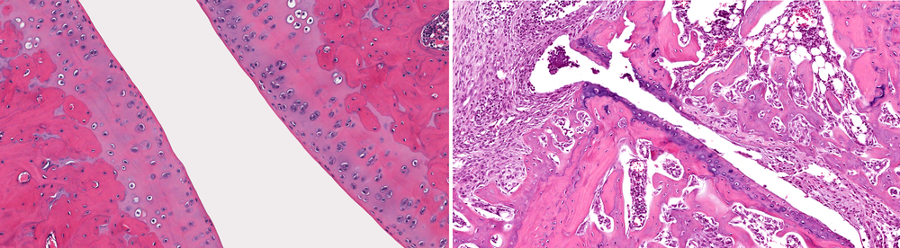 Microscopic view of normal healthy joint (left) when compared to joint with osteoarthritis with loss of articular cartilage, fibrosis, inflammation and loss of bone (right).