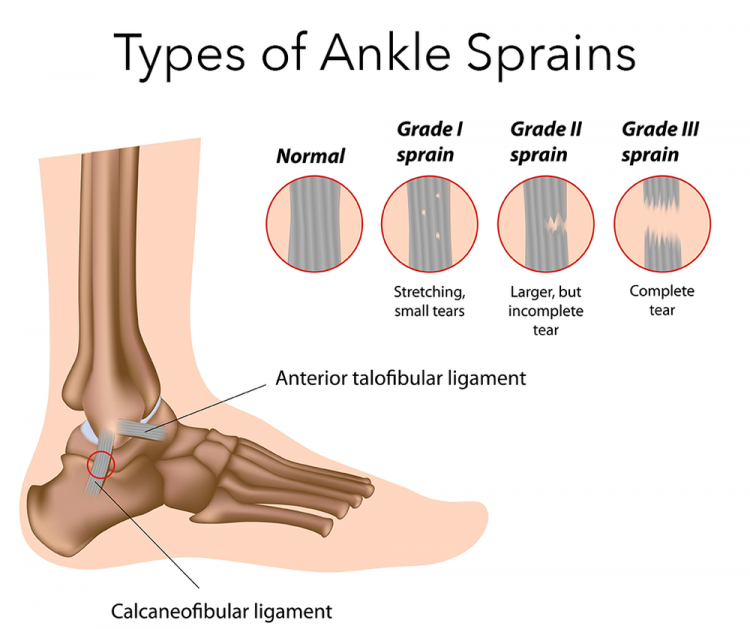 How to Treat an Ankle Sprain with Electrostimulation