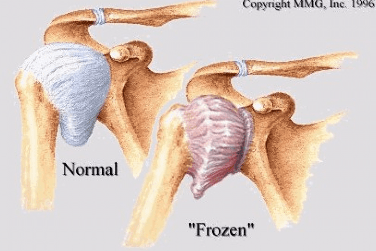 How to release a frozen shoulder - Harvard Health