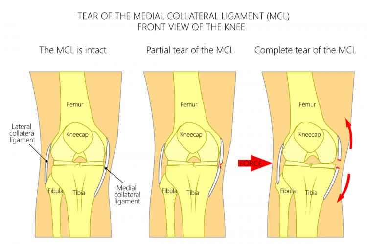MCL Surgery for Athletes with Injuries & Tears