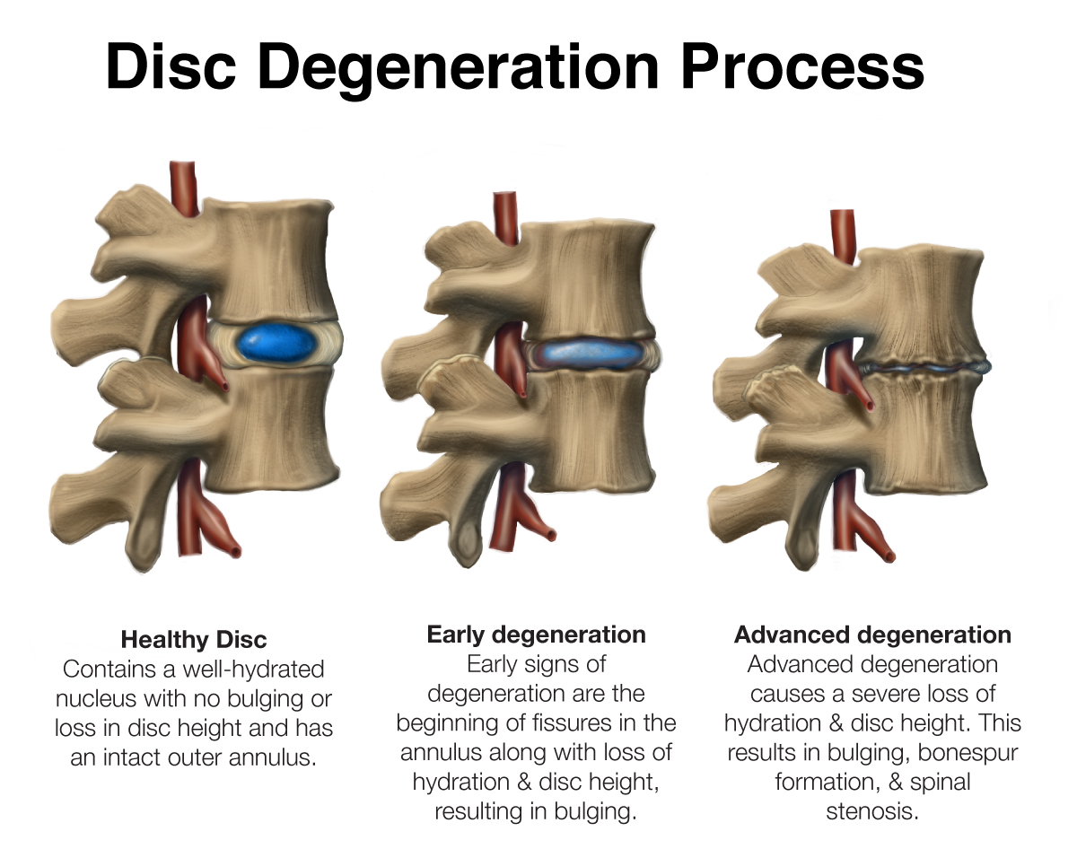 Lumbar Disc Herniation: Frequently Asked Questions