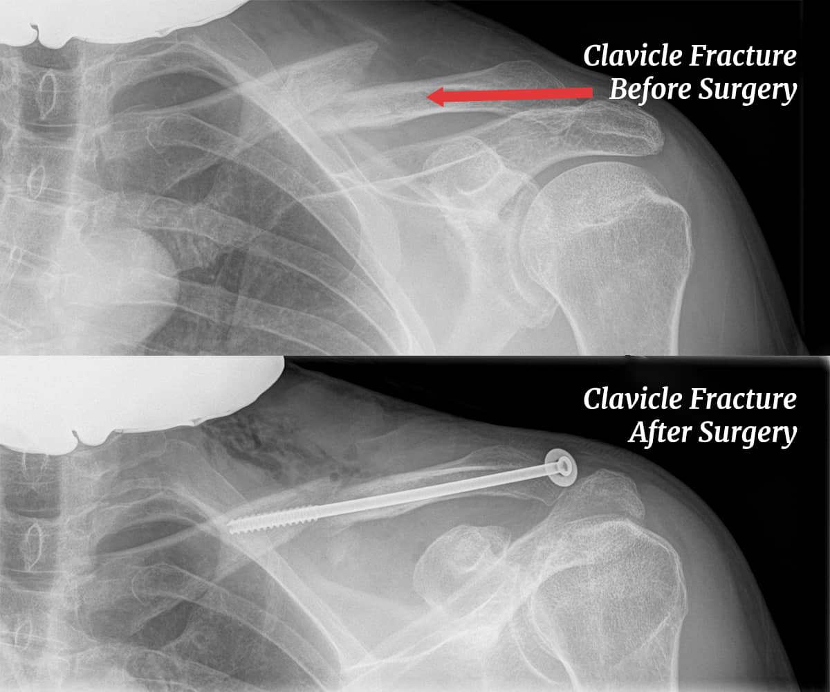 Clavicle Fracture Xray