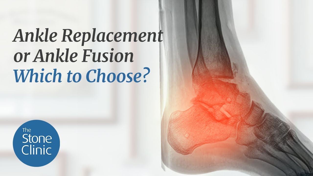 Alternative to Ankle Fusion 
