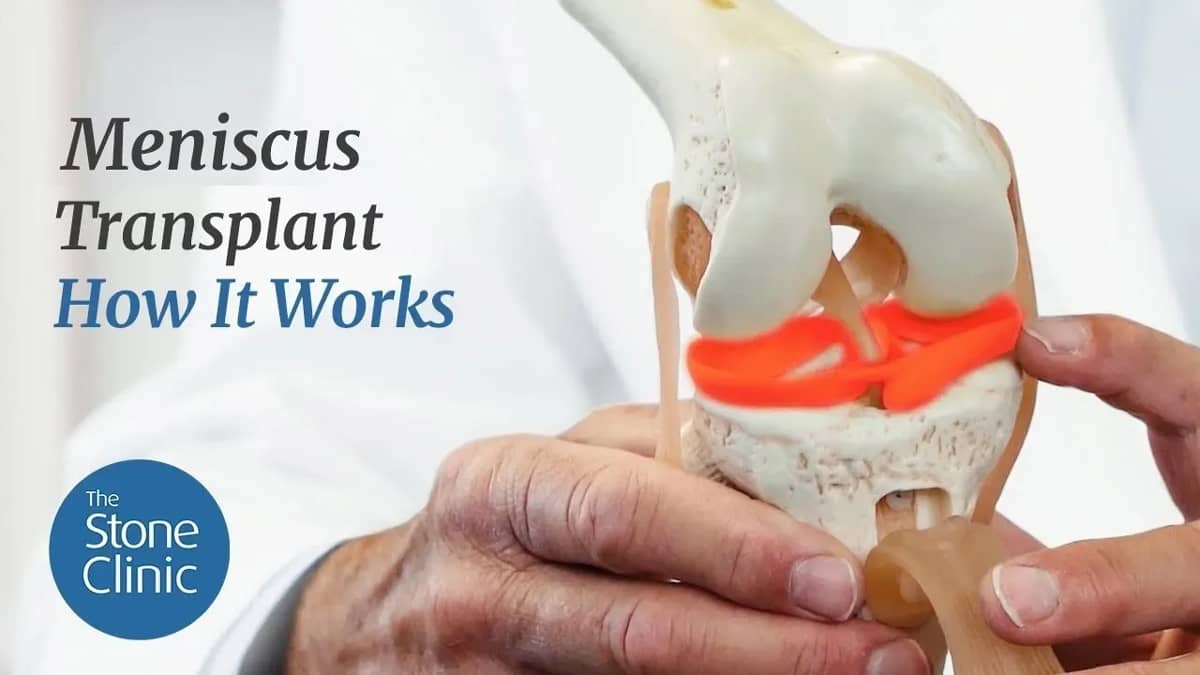 How Meniscus Transplants Work