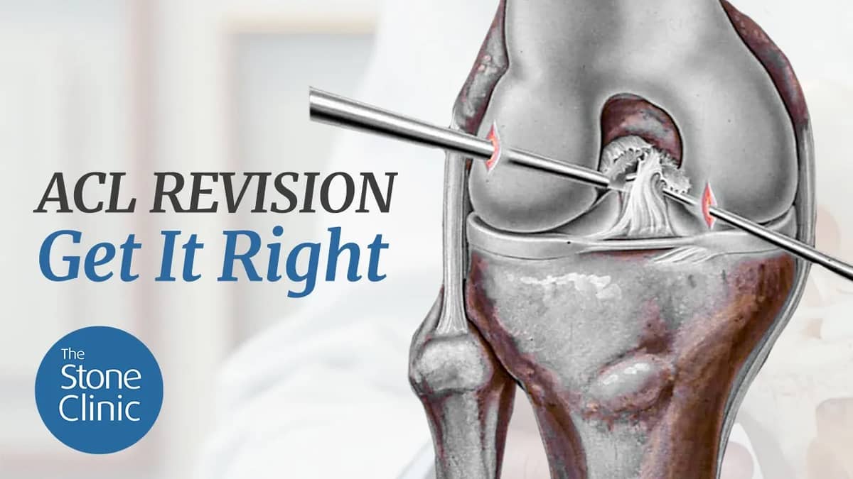 ACL Reconstruction Revision How to Get it Right