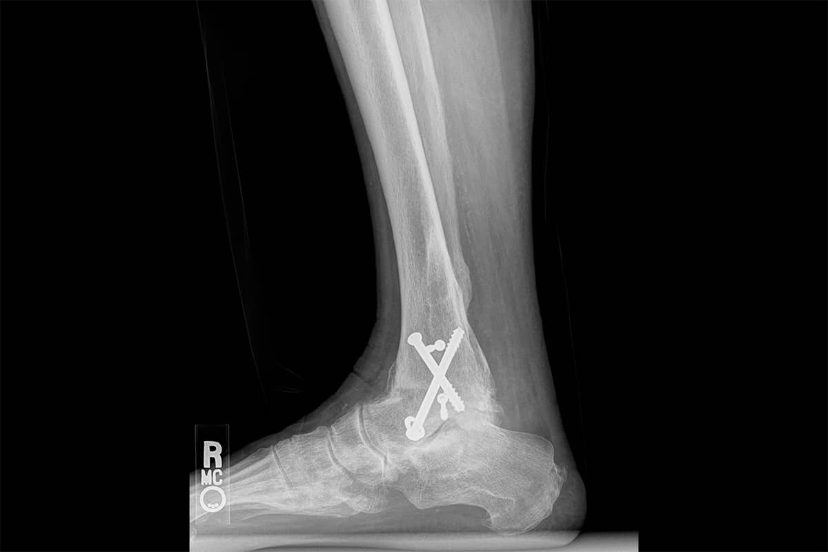 Alternative to Ankle Fusion