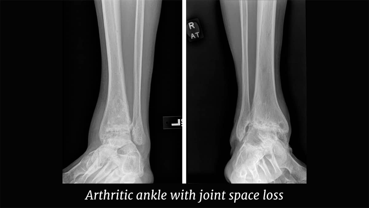 Ankle Arthritis Treatment: Know Your Surgeon’s Bias