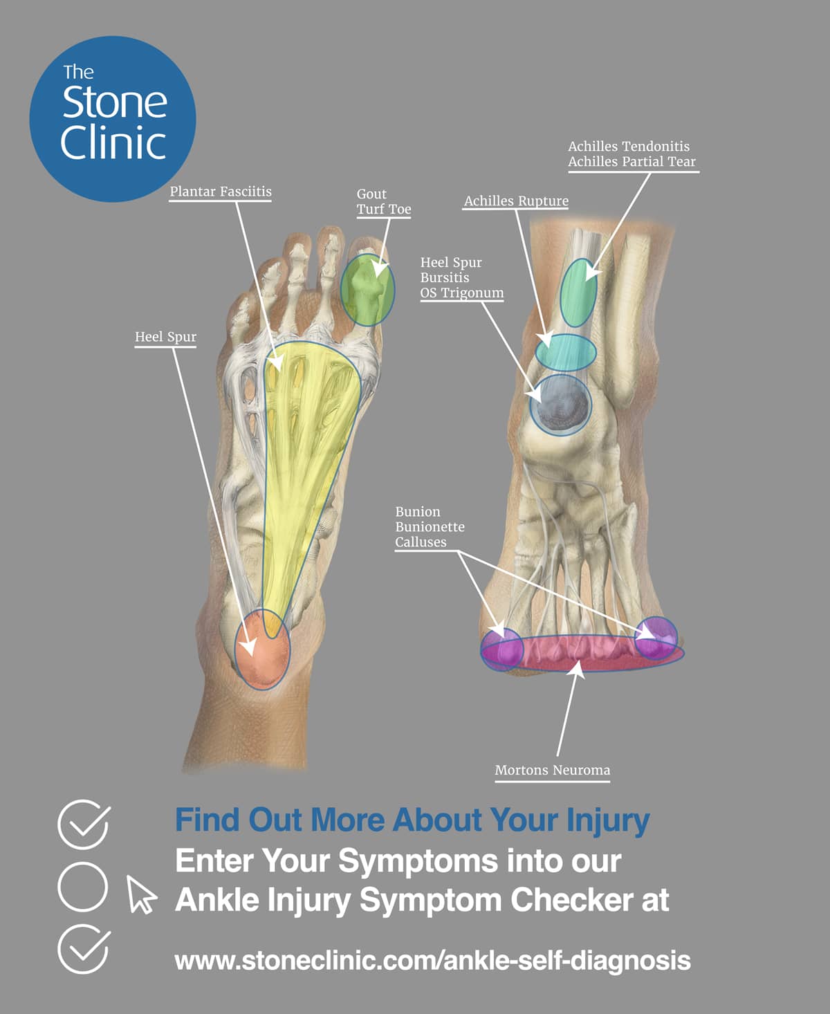 Plantar Fasciitis: Self-Diagnosisand Self-Treatment For Heel Pain eBook :  Witkowski, Gilberto: Amazon.com.au: Kindle Store