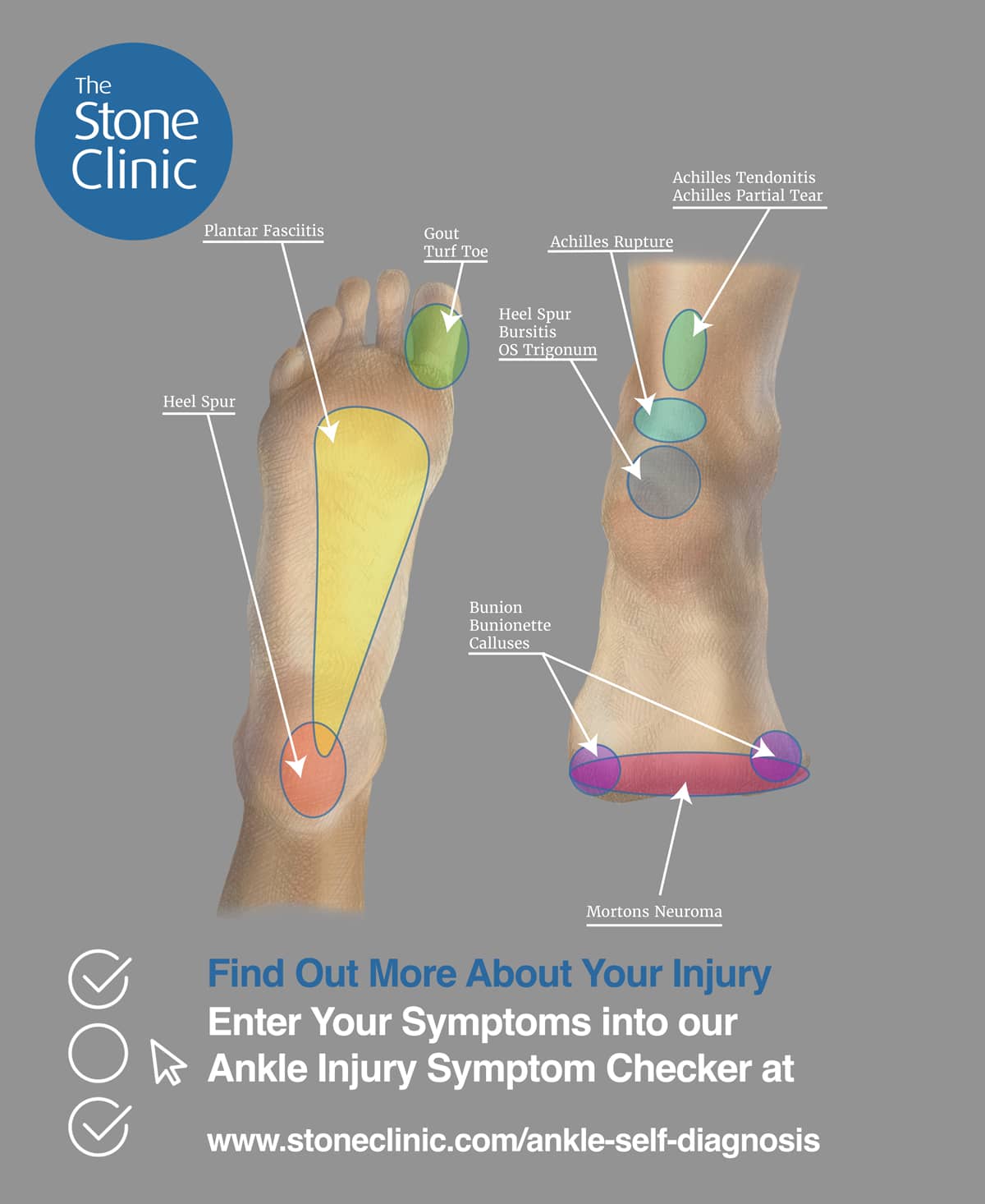 Foot Bruise Symptoms, Causes & Common Questions | Buoy