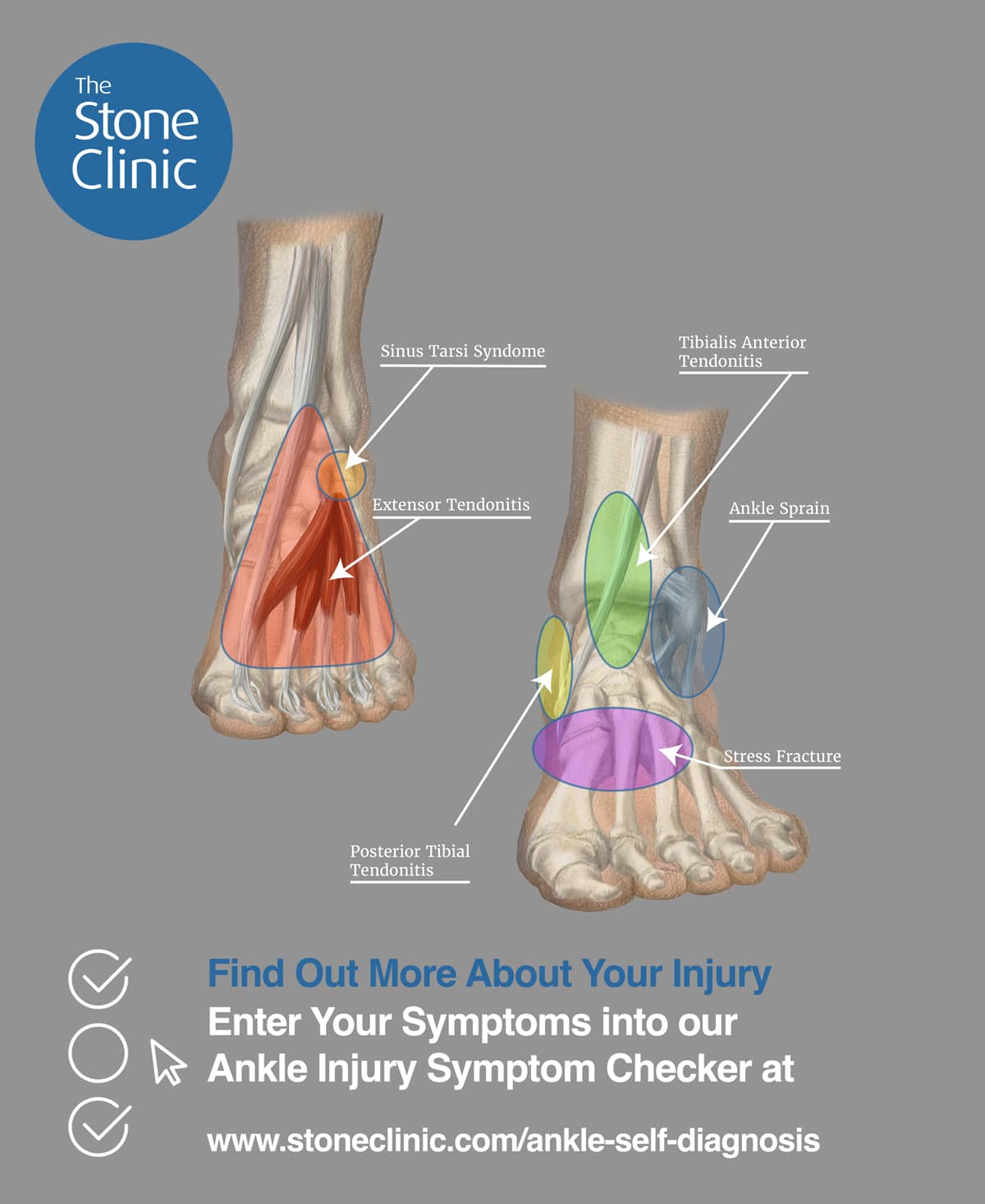 Lateral Ankle Sprain | Complete Physio