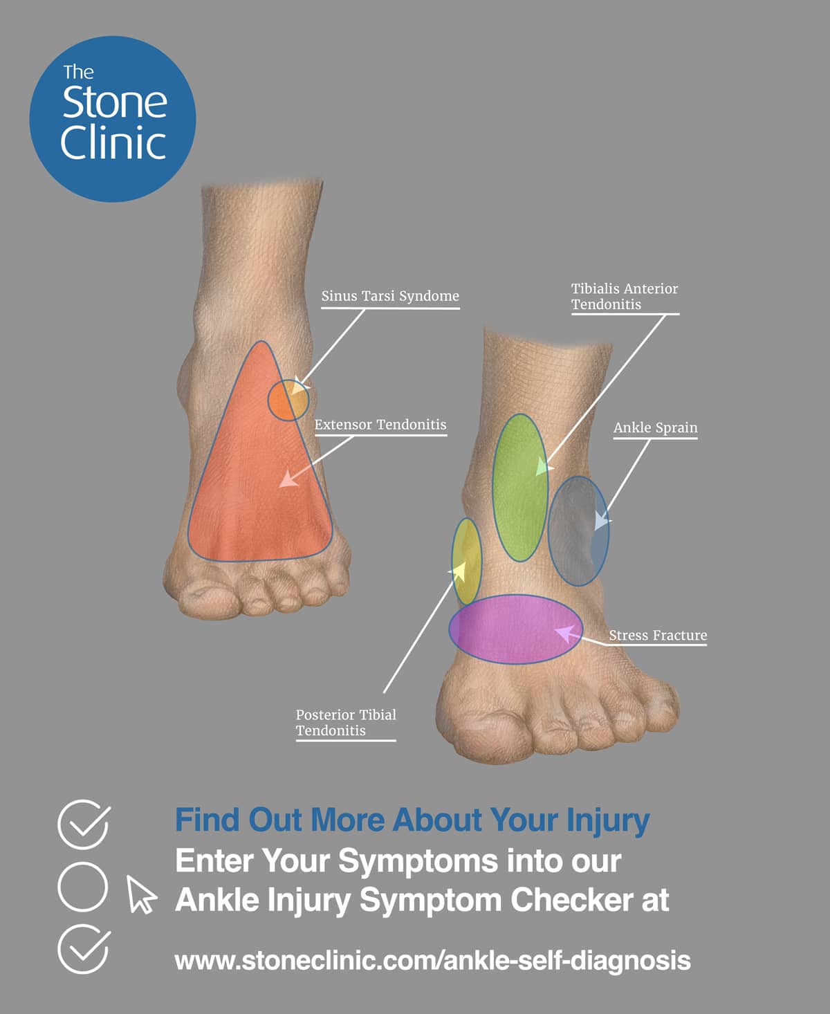 Hurt Your Ankle? Use Our Ankle Pain Symptom Checker Tool