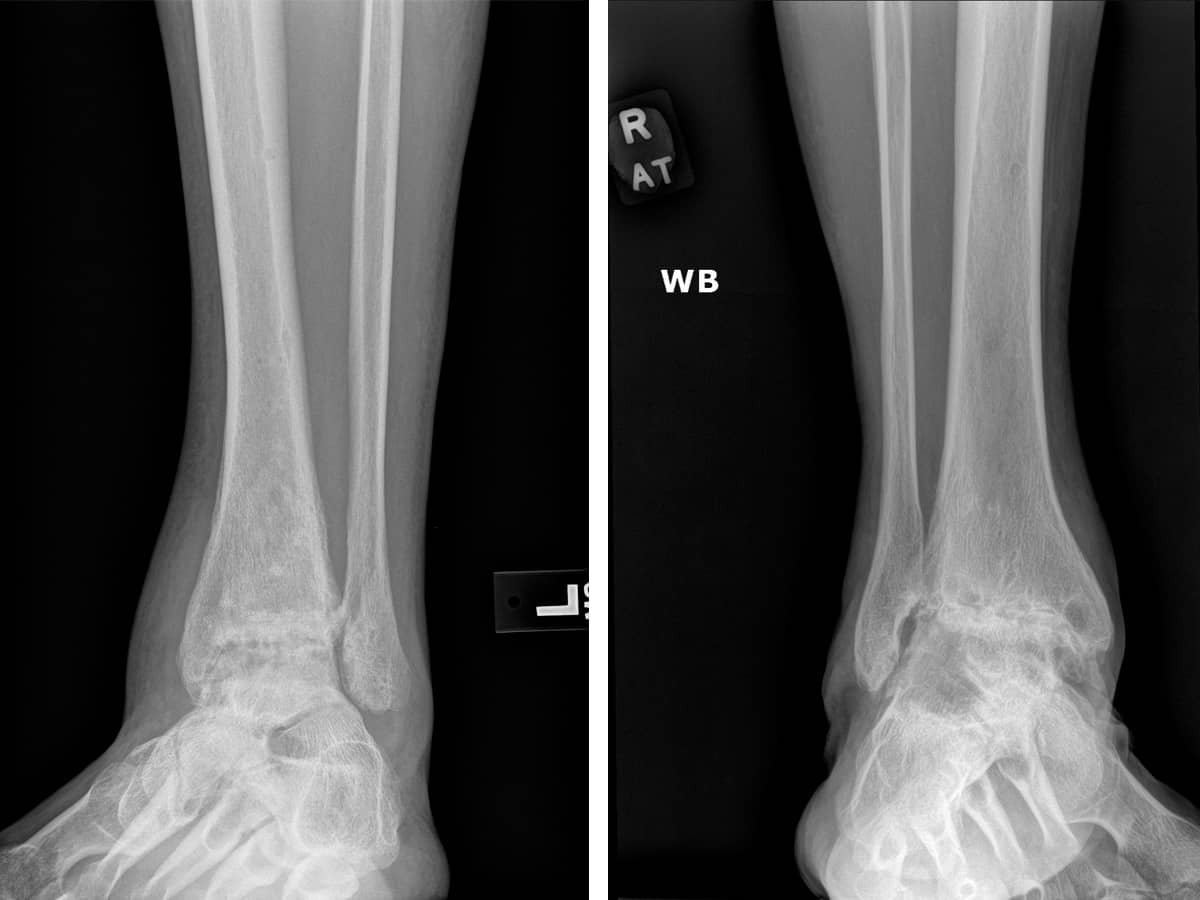 When to Have Ankle Surgery