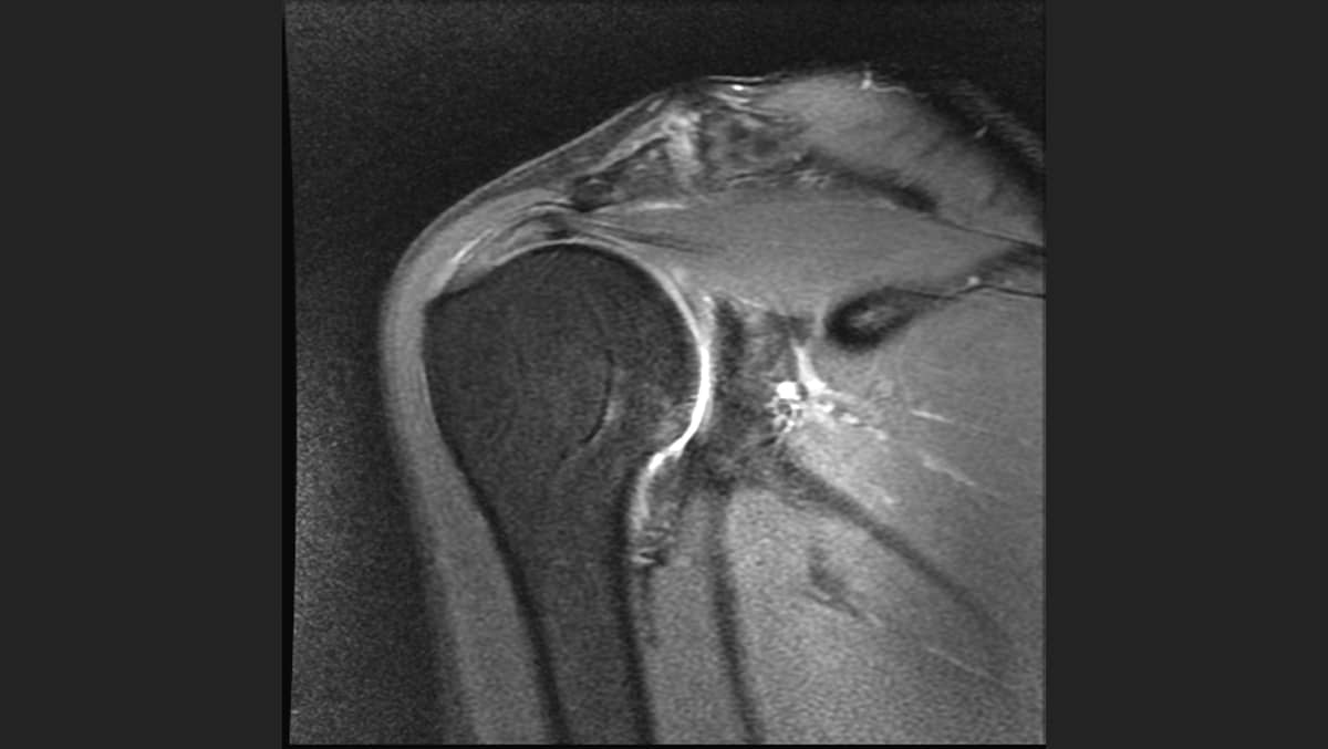 Non-Operative Approach to Rotator Cuff Injuries