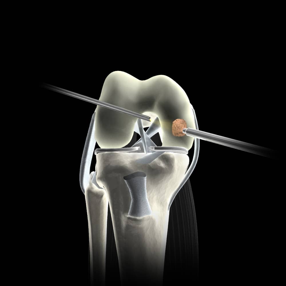 Articular Cartilage Surgery Repair Diagram