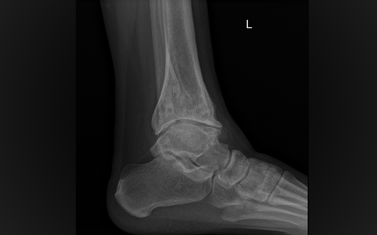 How to Treat Arthritic Ankles 