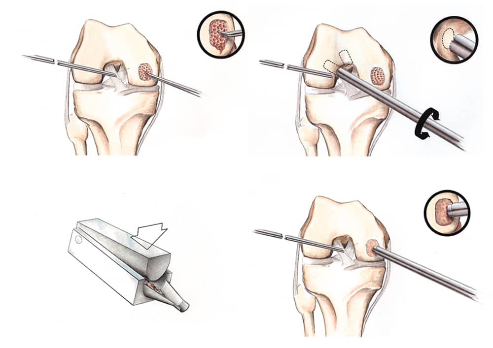 Articular-Cartilage-Paste-Grafting-Procedure-Diagram