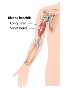 Biceps Tendinitis