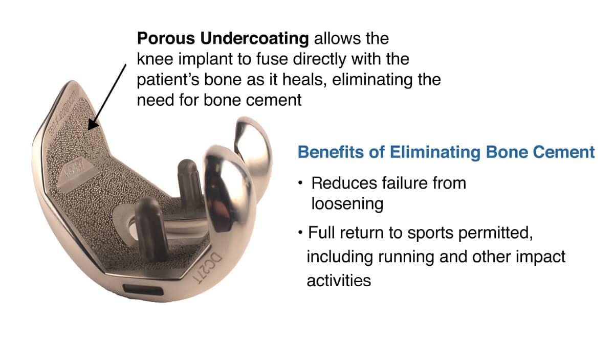 MAKO Triathlon Cementless Total Knee Replacement Implant