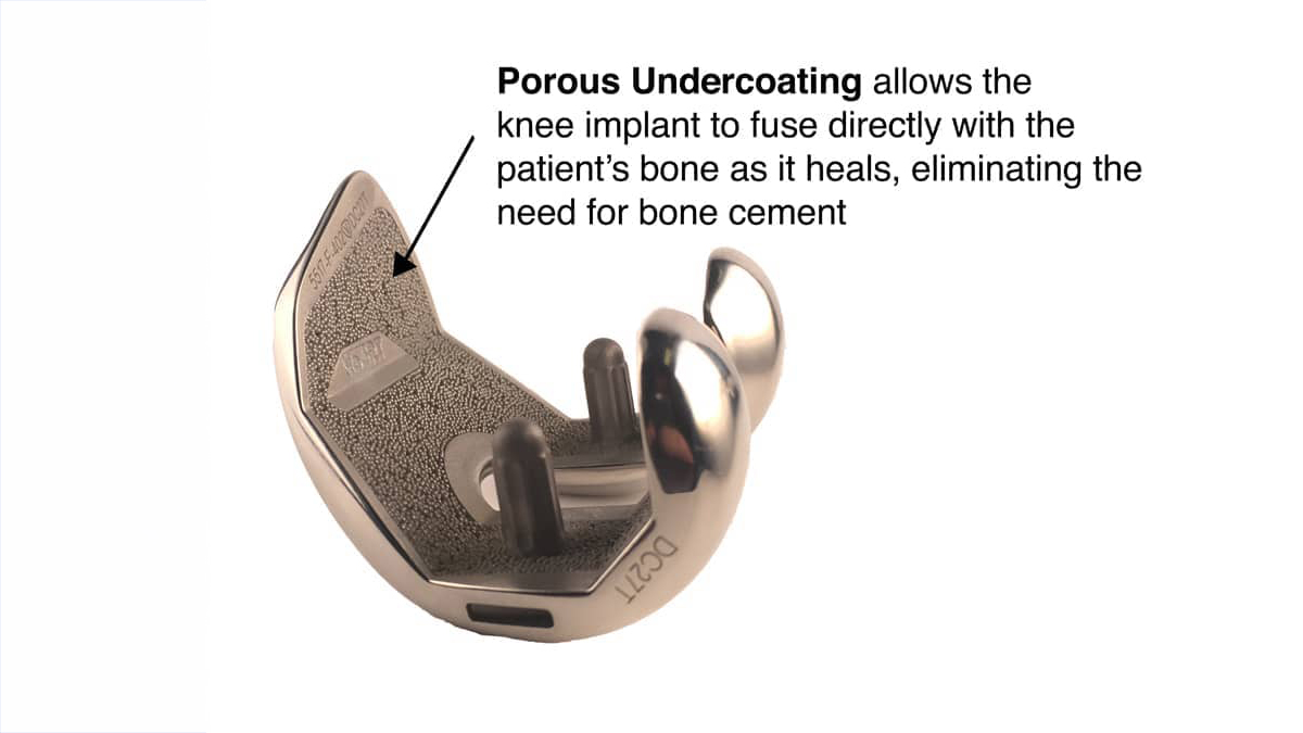 Cementless-Total-Knee-Implant-MAKO