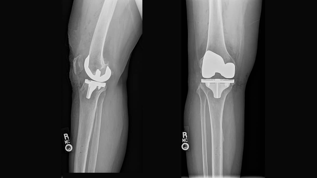 Robotic Total Knee Replacement