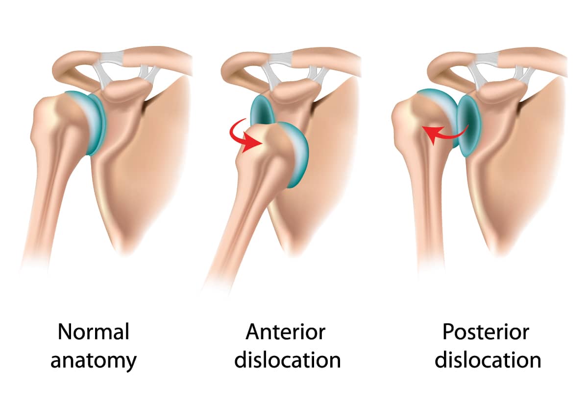 When to Have Surgery for Dislocated Shoulder