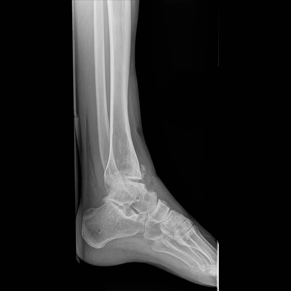 Avoid Ankle Fusion Surgery