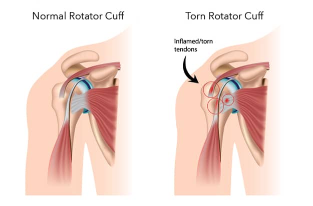 best way to sleep with torn rotator cuff