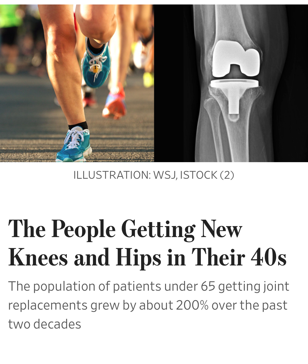 The People Getting New Knees And Hips In Their 40s Press on The Stone Clinic & Kevin R. Stone, MD