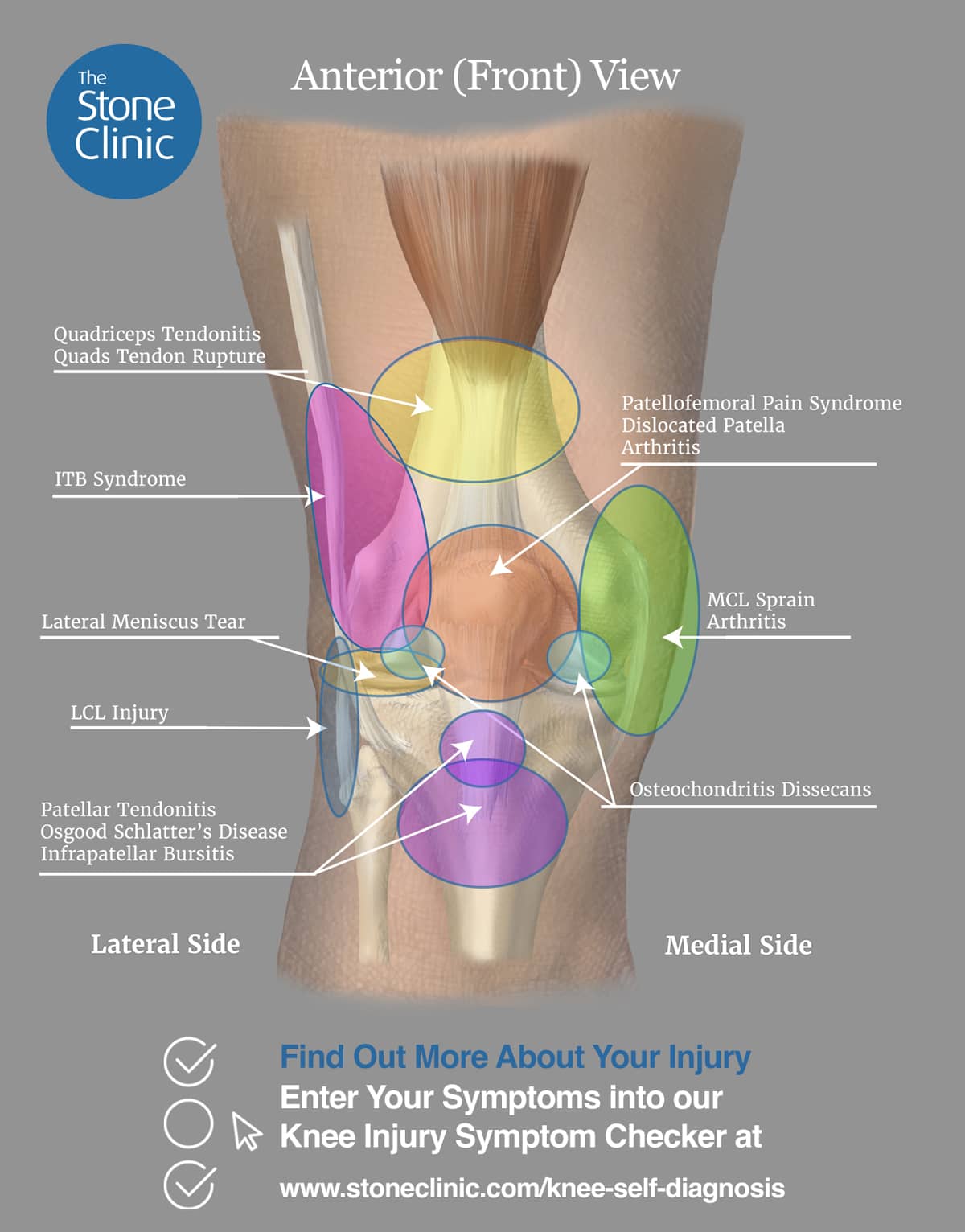 Knee Pain Symptom Checker Online Injury Self Diagnosis Tool