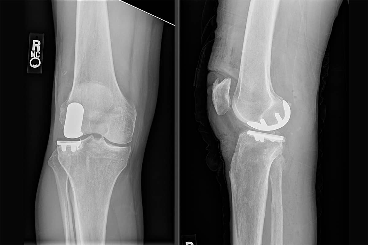 Lateral Partial Knee Replacement for Bone on Bone Arthritis