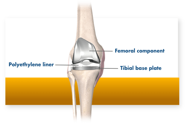 MAKO Robotic Knee Replacement Implant