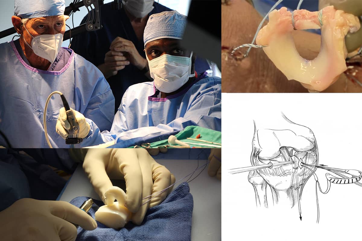 Surgeon with Most Meniscus Transplant Experience