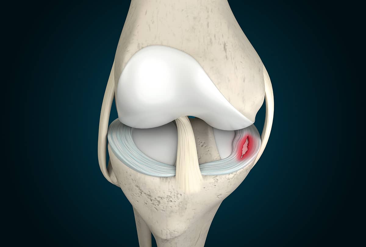New Meniscus Tear Treatments