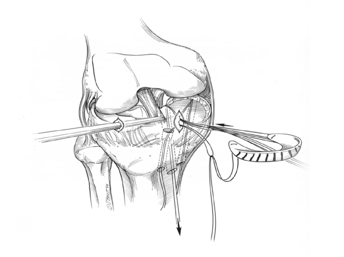 Meniscus Transplantation Illustration