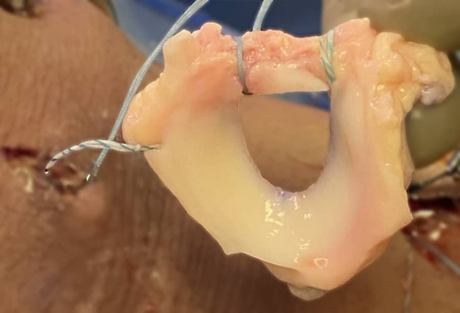 Meniscus Allograft Transplant Tissue for Replacing Meniscus