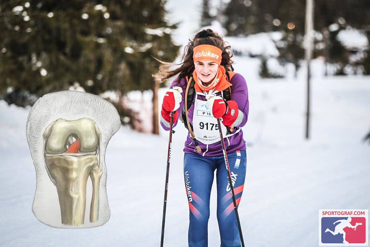 ACL Revision Reconstruction Surgery Patient Skiing Cross Country Marathon