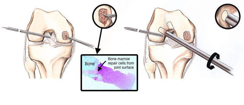 Why Microfracture Surgery Fails