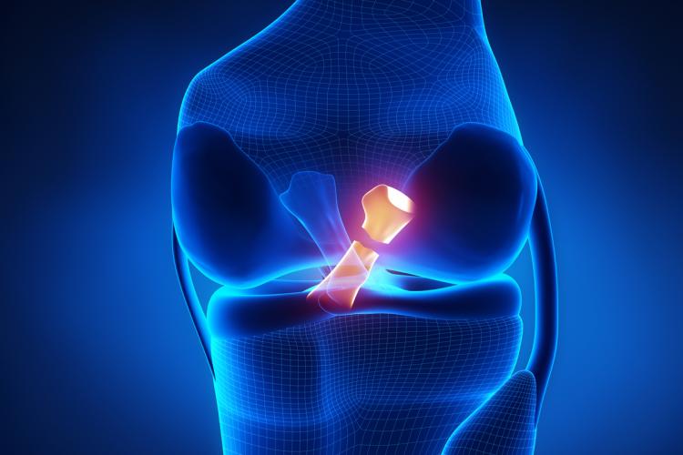 PCL Injuries: Never simple, and not to be ignored The Stone Clinic