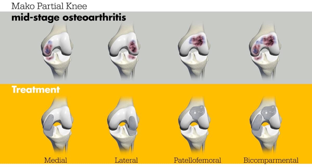 Bicompartmental Robotic Knee Replacement