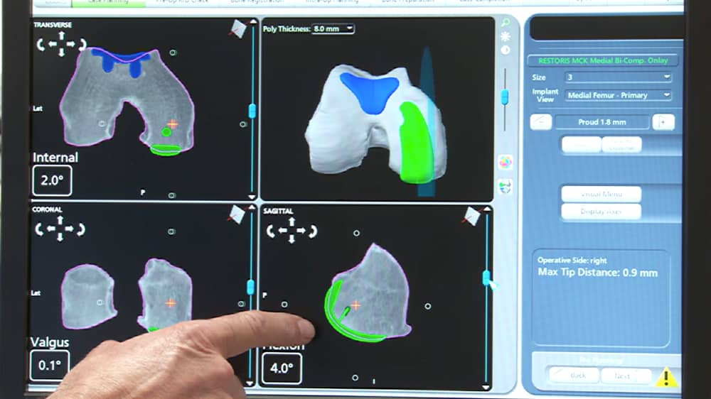 MAKO Surgery Planning Screen of CT Scan