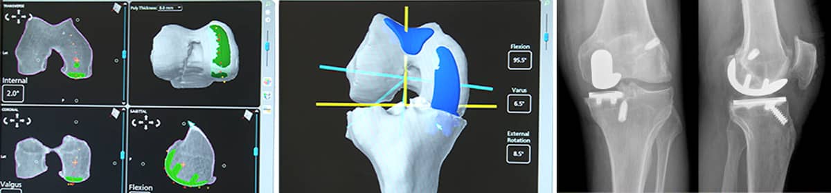 Partial Knee Replacement at the Robotic Joint Center