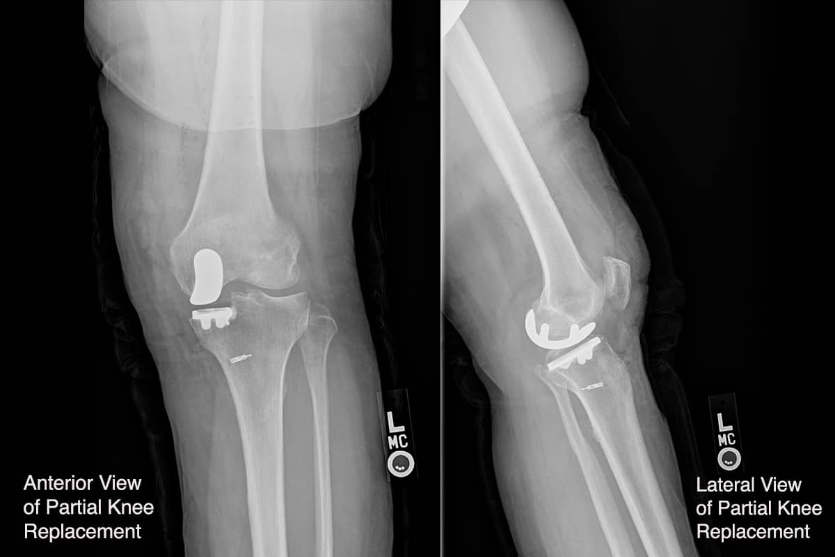 Partial Knee Replacement X-Rays Mako Robotic Surgery