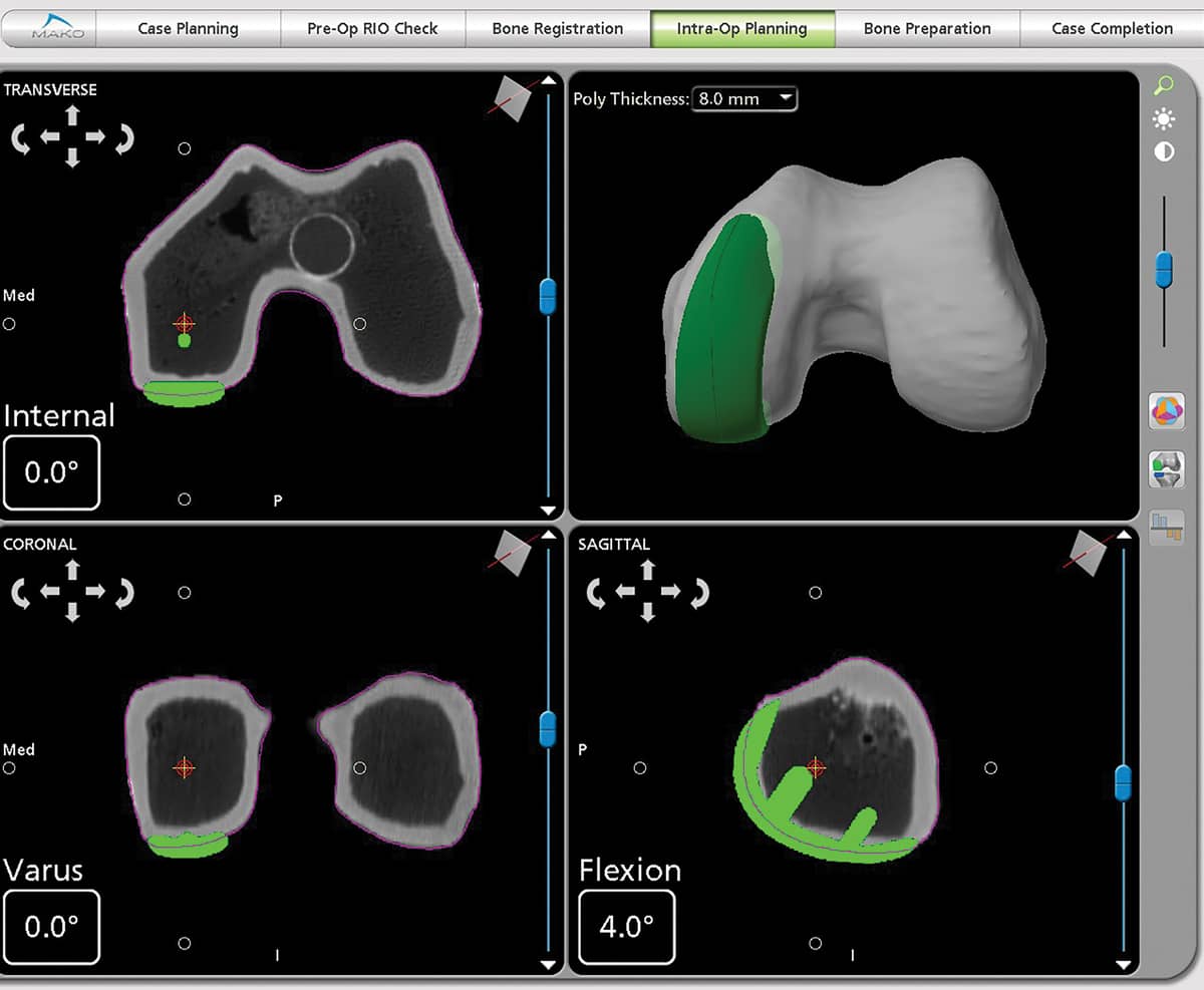 Mako Robot Partial Knee Replacement Planning