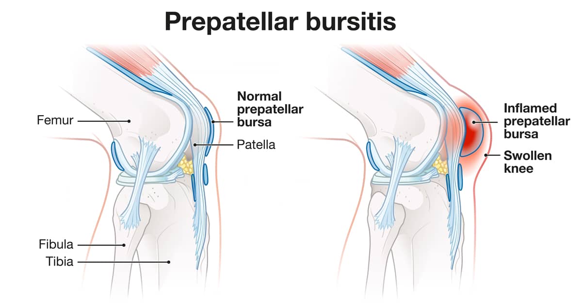 Knee Bursitis