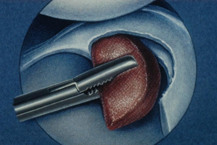 Repair of Segmental Meniscal Defects The Stone Clinic
