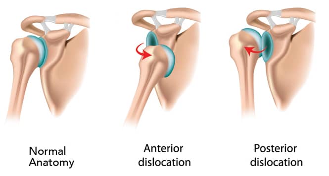Shoulder Dislocation Anterior & Posterior